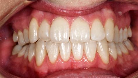 Tandregulering – Få det flotteste smil med en usynlig tandbøjle.